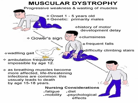 Muscular Dystrophy Image